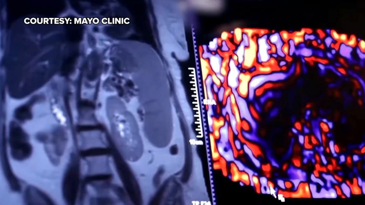 Healthy SA: Battling liver cancer, a disease which often has no symptoms early on — KENS 5 (San Antonio), Napa Health news