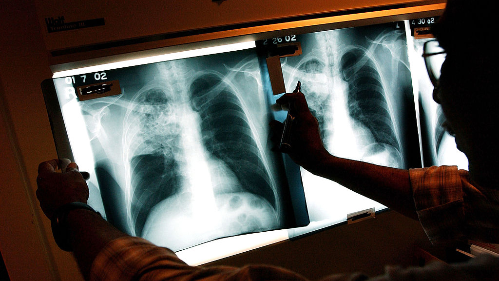 2 active tuberculosis cases traced to San Francisco strip club — KTVU FOX 2 Bay Area, Napa Health news